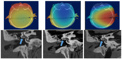 top row shows 3 saggital images of the head with rainbow colorscale showing areas affected by ionizing radiation. bottom row shows 3 correlated temporal bone anatomy scans in black and white, with blue arrows indicating key location