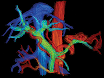 4D flow MRI
