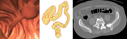 polyp