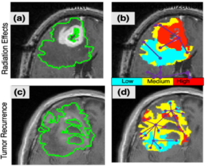 Figure 5: Preliminary results for lesion complexity features. (b), (d) demonstrate undirected subcompartment graphs on Gd-T1w MRI for (a) treatment effects, and (c) tumor recurrence. Graph complexity measures (density, transitivity, assortative) will be computed on these sub-graphs to create a lesion complexity signature on a per-voxel basis.