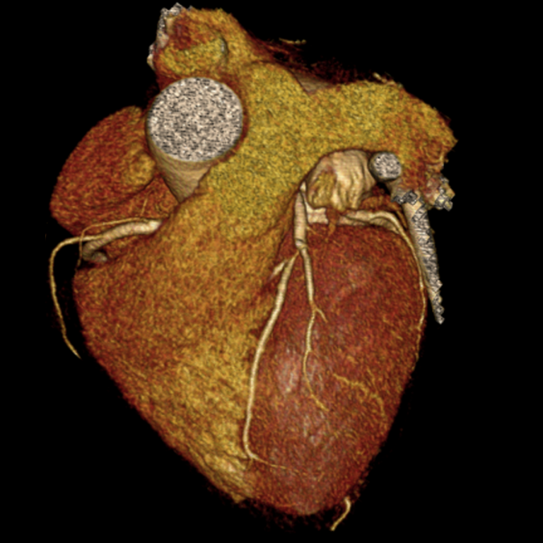 Cardiovascular imaging CCTA image