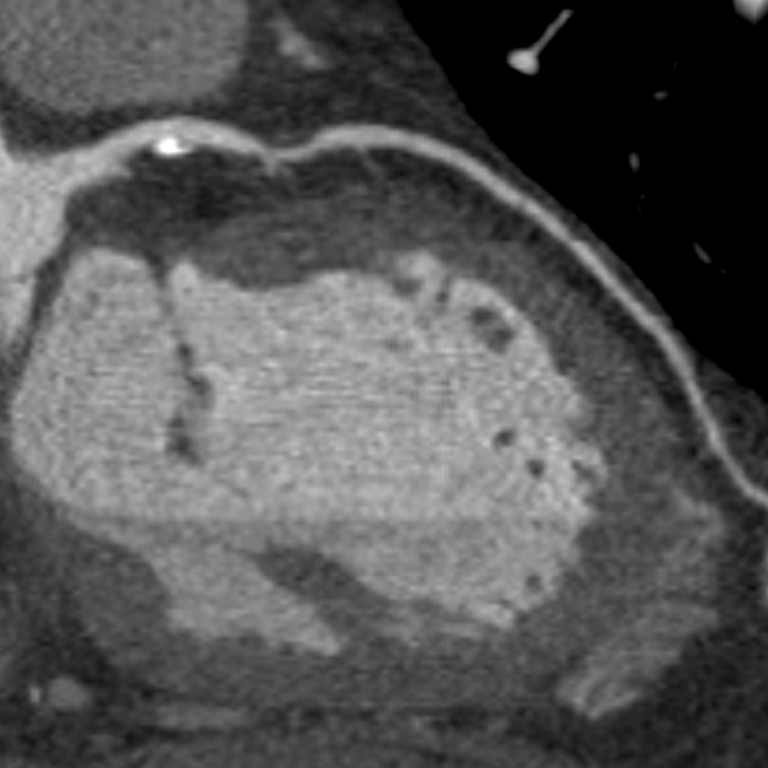 Cardiovascular imaging CCTA2 image
