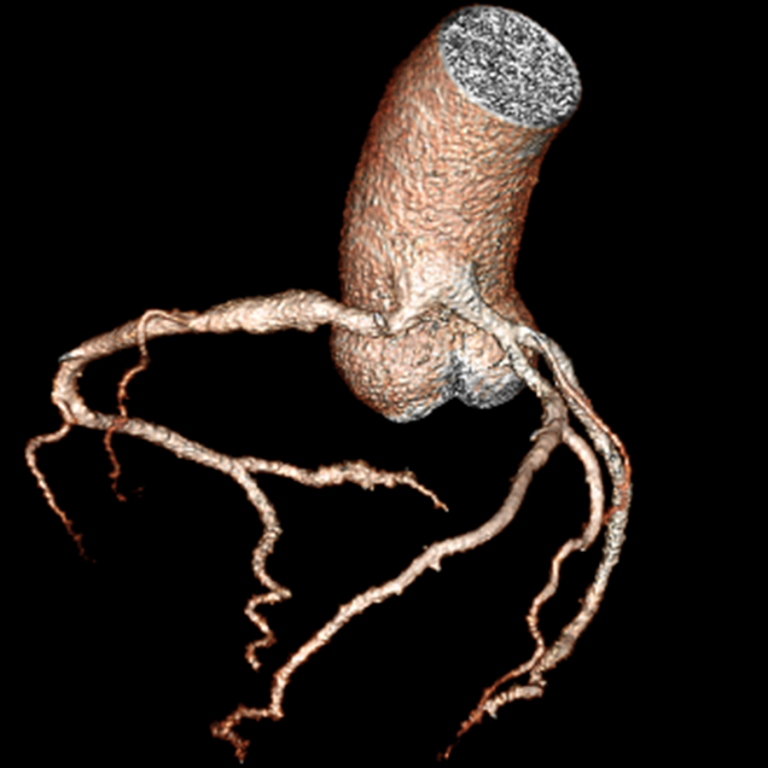 Cardiovascular imaging CCTA image
