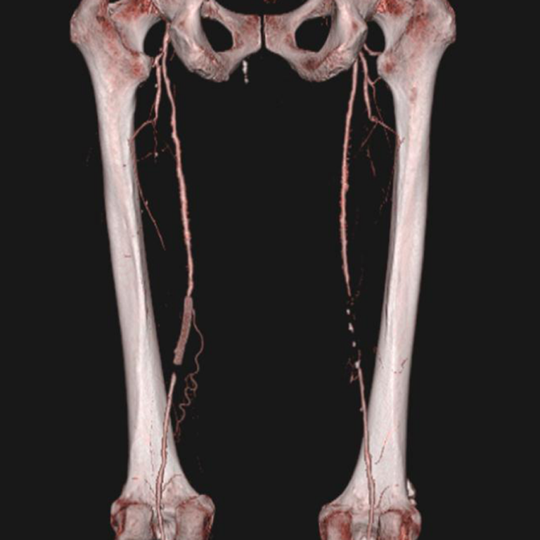Cardiovascular imaging CAT runoff image example