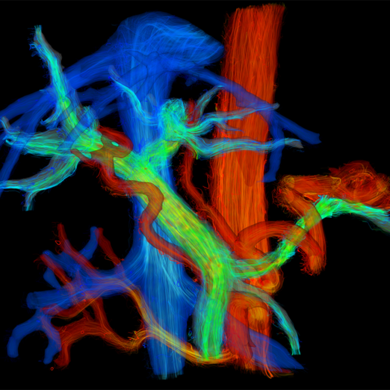 Cardiovascular imaging LIRP 4D flow