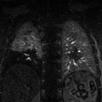 cardiovascular imaging PE MRA image