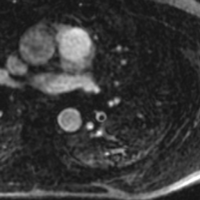 Cardiovascular imaging PE MRA image