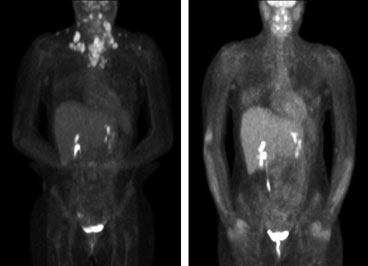 PET/FDG scans before and after chemotherapy in a young woman with nodular sclerosing Hodgkin’s lymphoma.
