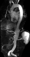 Cardiovascular imaging aortic dissection MRA image