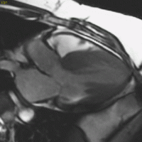 Cardiovascular imaging hypertrophic cardiomyopathy image