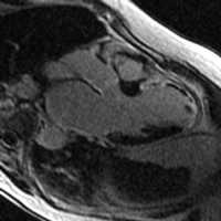Cardiovascular imaging late gadolinium enhancement