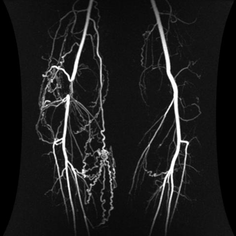 Cardiovascular imaging popliteal entrapment