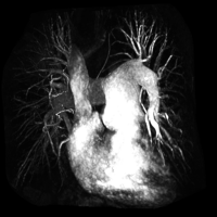 Cardiovascular imaging pulmonary hypertension image