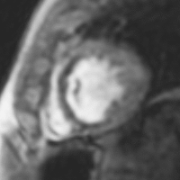 Cardiovascular imaging stress perfusion image