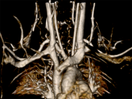 Cardiovascular imaging thoracic outlet syndrome MRA image