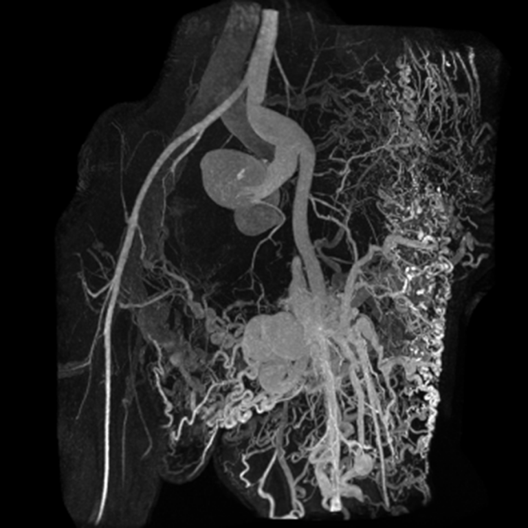 Cardiovascular imaging vascular malformation MRA image