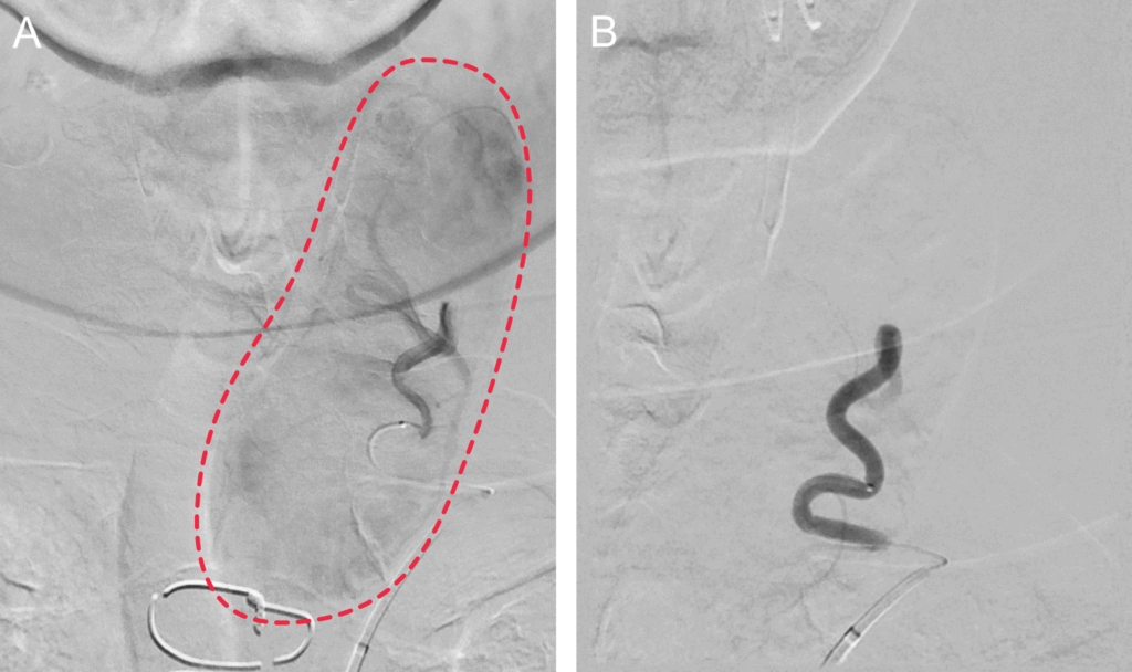Intra-procedure angiograms depicting the left thyroid gland pre-embolization (left) and post-embolization (right). Pre-embolization shows an area of blush, indicating the blood supply. Post-embolization shows the absence of blood supply as the supply is blocked during the procedure.