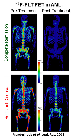Figure showing four 18F‑FLT PET scans comparing acute myeloid leukemia response. Top row: complete remission, pre‑treatment scan shows increased uptake, post‑treatment scan shows minimal uptake. Bottom row: resistant disease, both pre‑ and post‑treatment scans show high uptake. Adapted from Vanderhoek et al., Leuk Res. 2011.