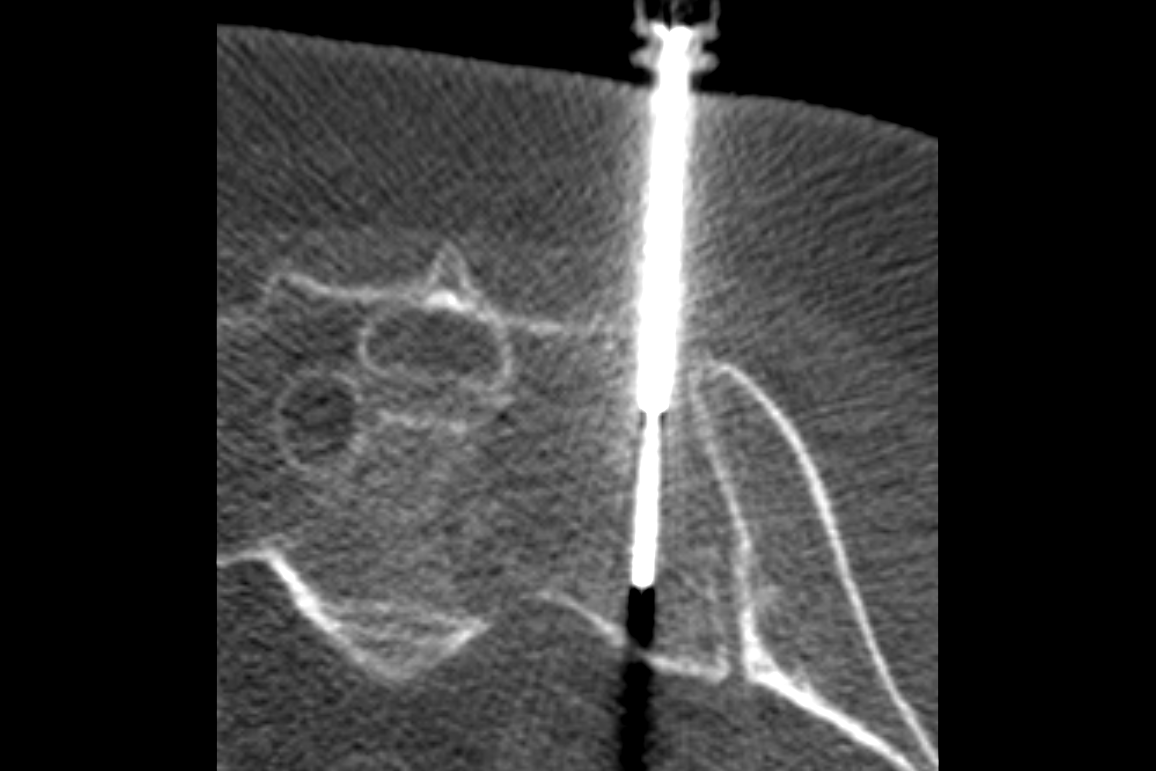 black and white medical image of a sacral tumor biopsy where a white instrument is shown entering a grey body