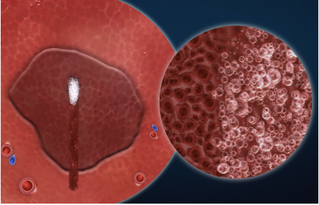 Representation of histotripsy bubble cloud destroying targeted liver tumors non-invasively and without heat or ionizing radiation (animation provided by Histosonics. Inc.)