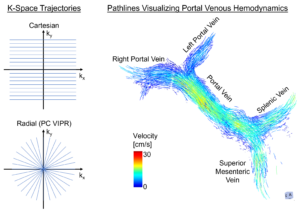 Cartesian and radial k-space encoding techniques both allow for acquiring 4D Flow MRI data of blood flow in the portal vein of the liver: Velocity color-coded pathlines visualize the flow from the splenic and superior mesenteric veins joining to form the portal vein and eventually splitting to form the right and left portal veins in the liver.