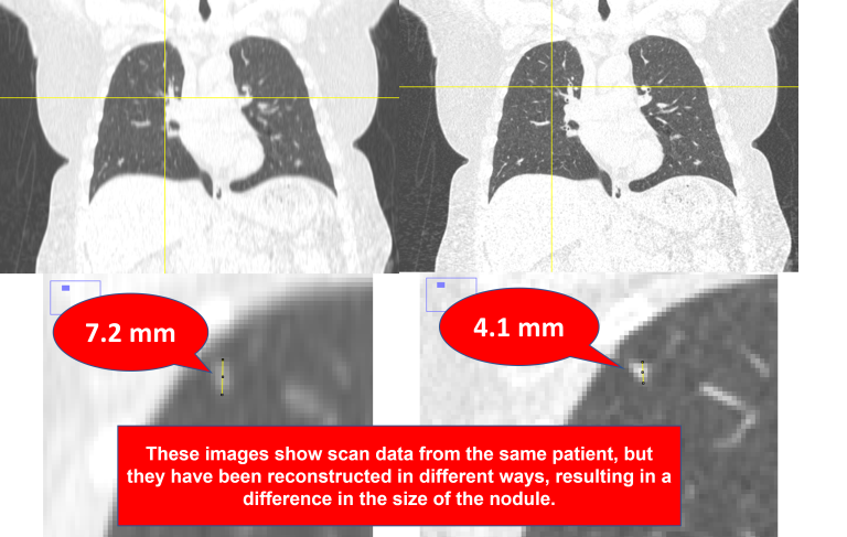 This example demonstrates how non-uniform reconstruction can affect medical images. (Photo courtesy of Timothy Szczykutowicz)