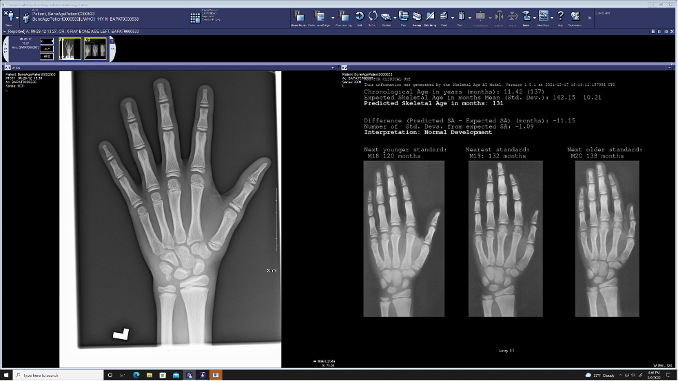Screenshot of a radiology PACS application displaying an X-ray of a child's left hand and wrist alongside an automated bone age assessment report with comparison images and skeletal age measurements